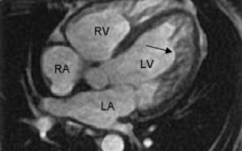 Imagenes RM cardiaca