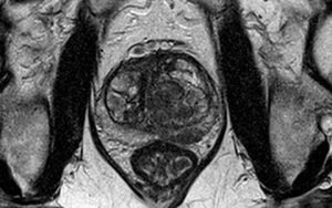 Resonancia Magnetica de prostata