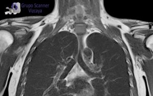 Resonancia Magnetica de Torax
