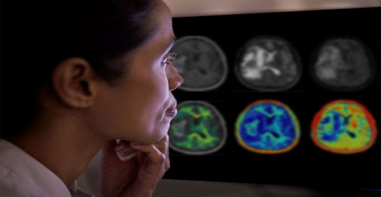 Philips y Synthetic MRI introducen una avanzada tecnología de imágenes cerebrales para la neurología