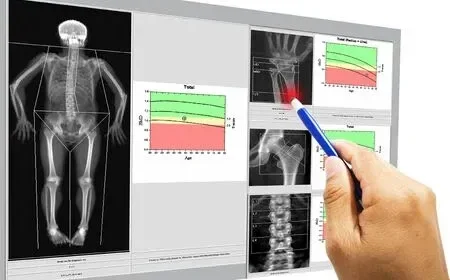 Entendiendo la Osteoporosis: La Importancia de la Prevención y la Detección Temprana