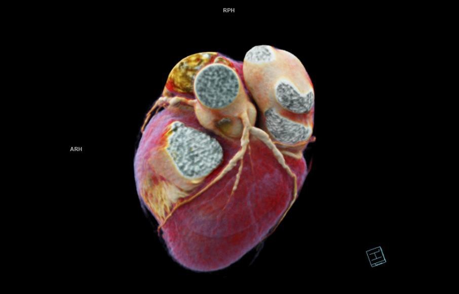 El TAC Cardiaco para evaluar y prevenir enfermedades cardiovasculares